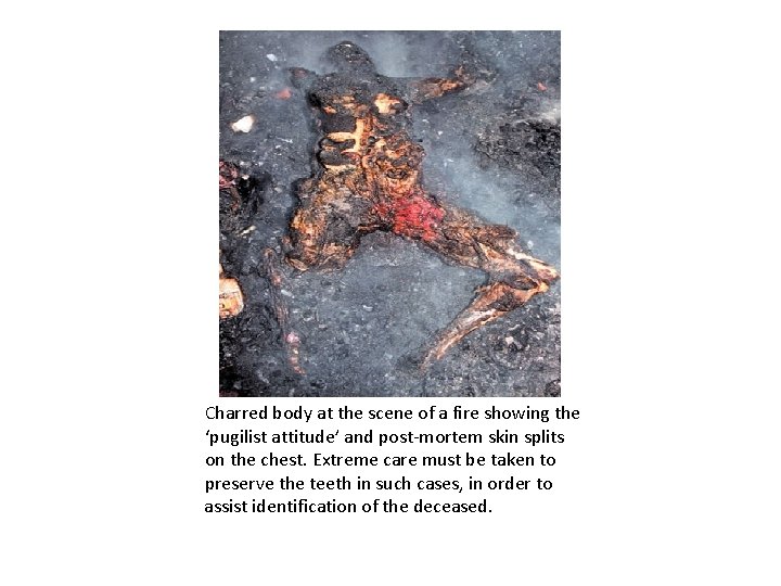 Charred body at the scene of a fire showing the ‘pugilist attitude’ and post-mortem
