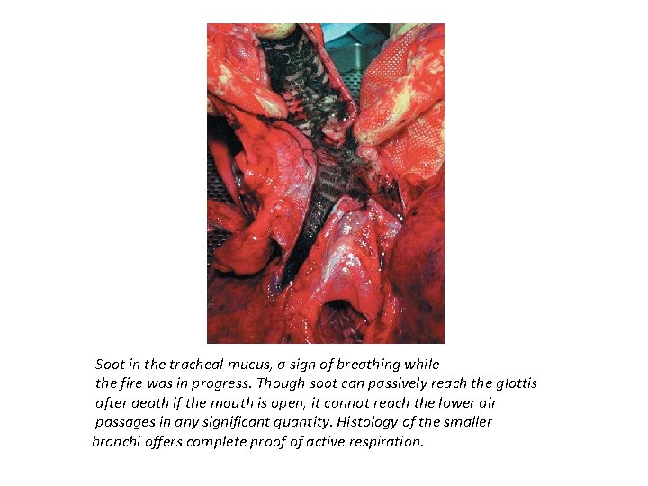 Soot in the tracheal mucus, a sign of breathing while the fire was in