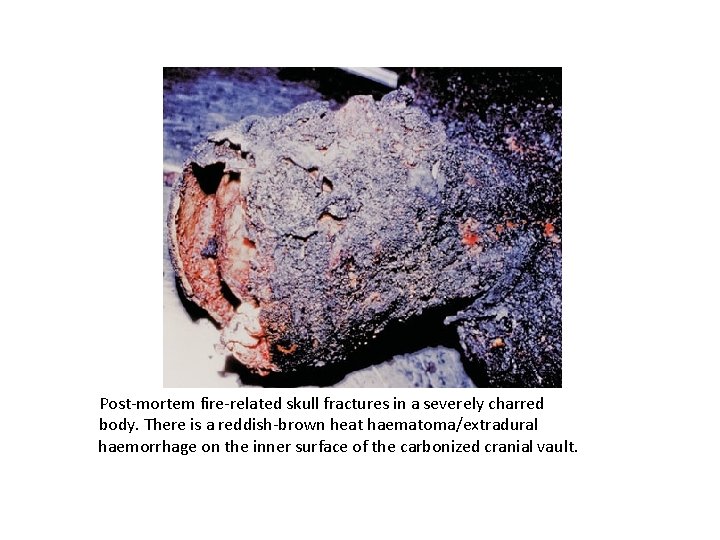 Post-mortem fire-related skull fractures in a severely charred body. There is a reddish-brown heat