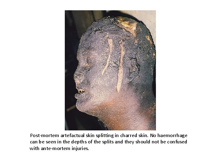 Post-mortem artefactual skin splitting in charred skin. No haemorrhage can be seen in the