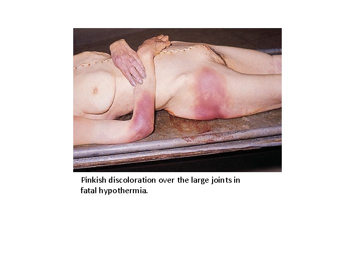 Pinkish discoloration over the large joints in fatal hypothermia. 