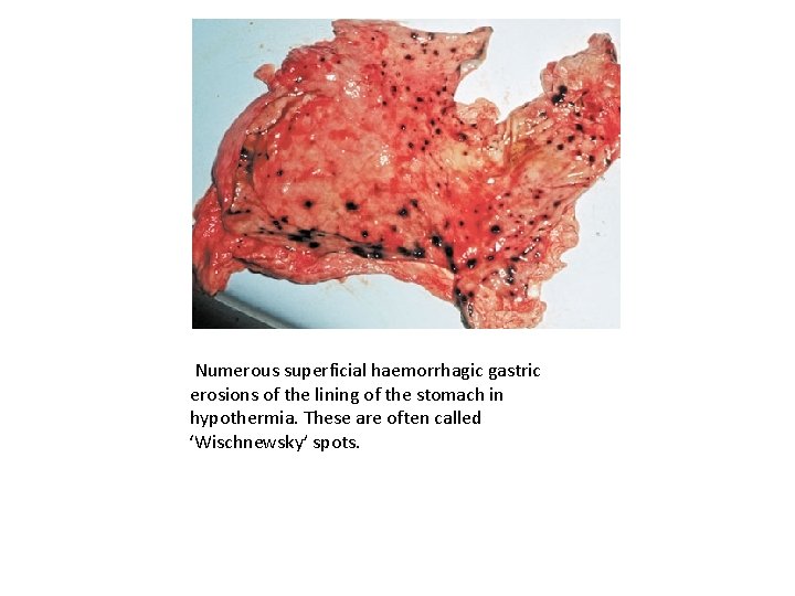 Numerous superficial haemorrhagic gastric erosions of the lining of the stomach in hypothermia. These