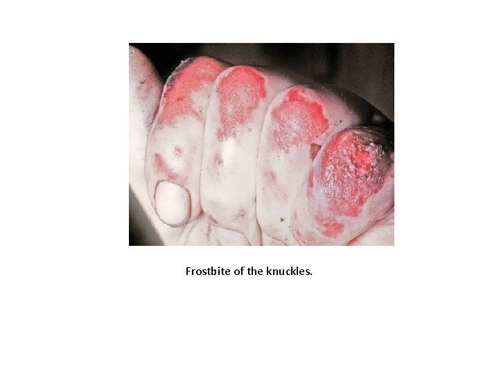 Frostbite of the knuckles. 