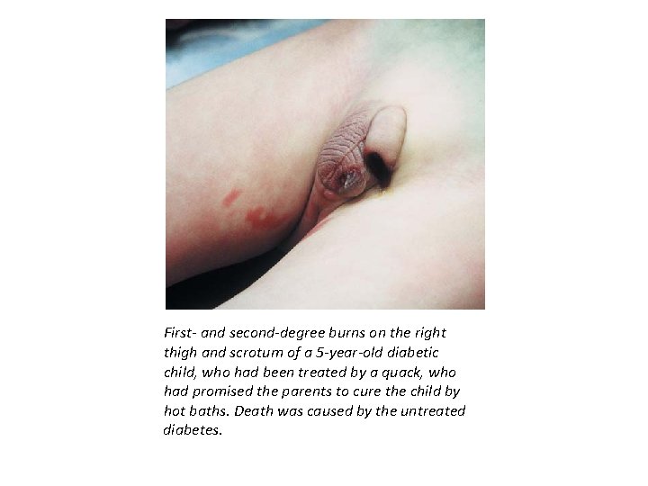 First- and second-degree burns on the right thigh and scrotum of a 5 -year-old