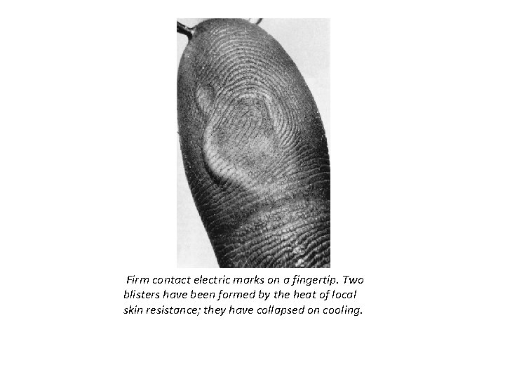 Firm contact electric marks on a fingertip. Two blisters have been formed by the