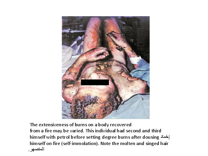 The extensiveness of burns on a body recovered from a fire may be varied.