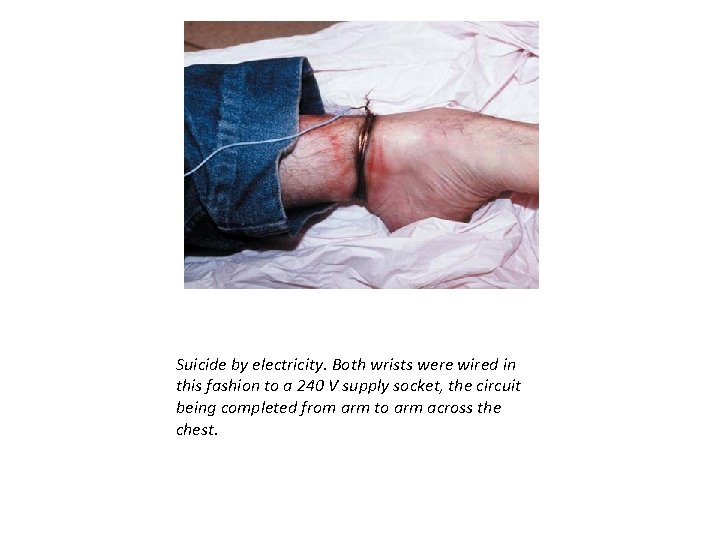 Suicide by electricity. Both wrists were wired in this fashion to a 240 V