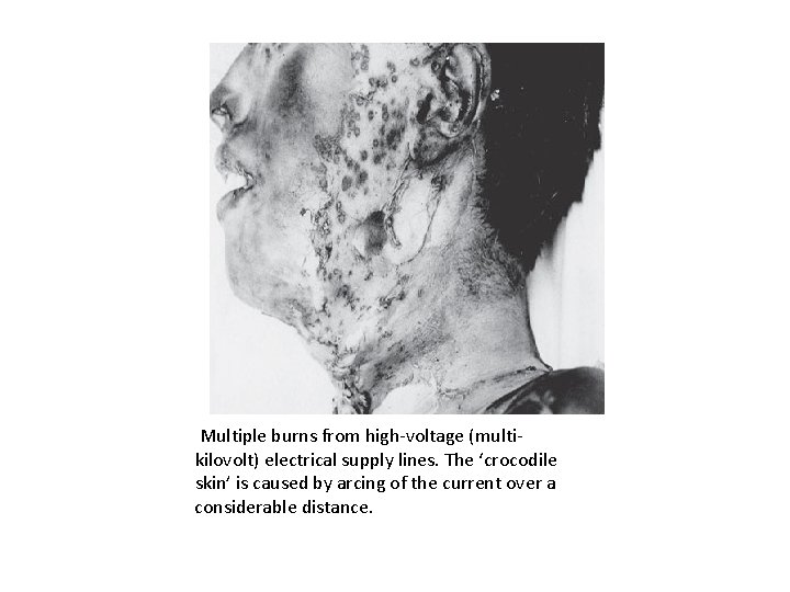 Multiple burns from high-voltage (multikilovolt) electrical supply lines. The ‘crocodile skin’ is caused by