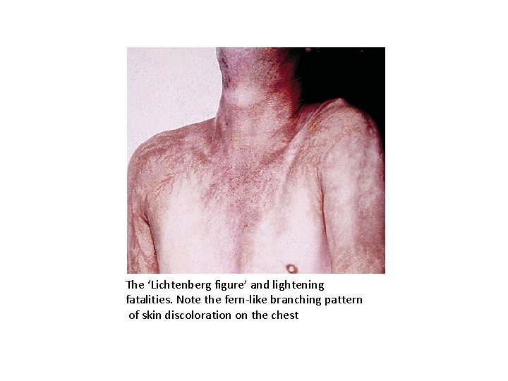 The ‘Lichtenberg figure’ and lightening fatalities. Note the fern-like branching pattern of skin discoloration