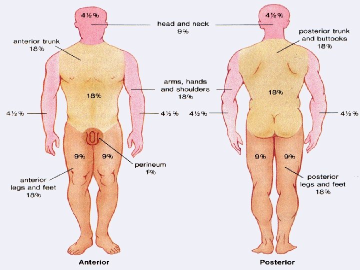 Factors affecting degree of burn A) Extent of burnt area: is determined by rule