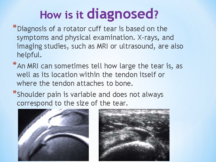 How is it diagnosed? *Diagnosis of a rotator cuff tear is based on the How is it diagnosed? *Diagnosis of a rotator cuff tear is based on the