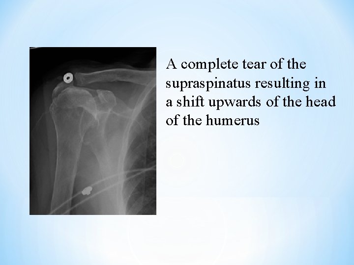 A complete tear of the supraspinatus resulting in a shift upwards of the head A complete tear of the supraspinatus resulting in a shift upwards of the head