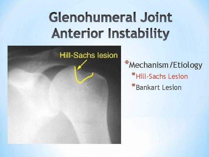 *Mechanism/Etiology *Hill-Sachs Lesion *Bankart Lesion *Mechanism/Etiology *Hill-Sachs Lesion *Bankart Lesion