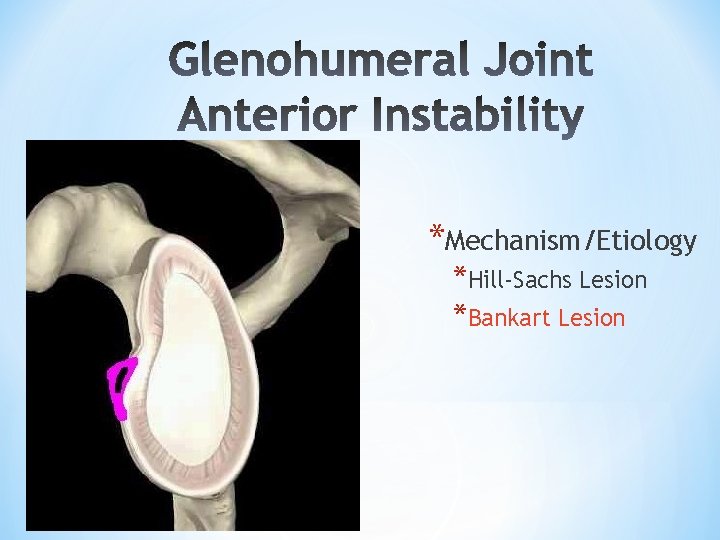 *Mechanism/Etiology *Hill-Sachs Lesion *Bankart Lesion *Mechanism/Etiology *Hill-Sachs Lesion *Bankart Lesion