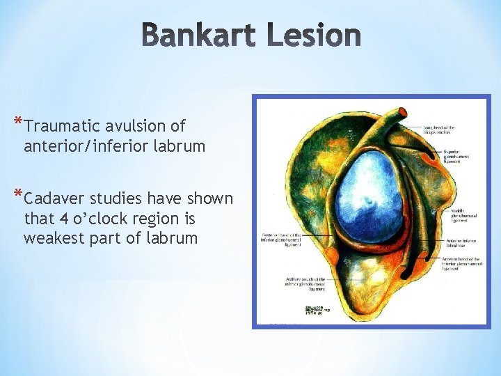 *Traumatic avulsion of anterior/inferior labrum *Cadaver studies have shown that 4 o’clock region is *Traumatic avulsion of anterior/inferior labrum *Cadaver studies have shown that 4 o’clock region is