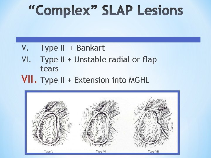 V. VI. Type II + Bankart Type II + Unstable radial or flap tears V. VI. Type II + Bankart Type II + Unstable radial or flap tears
