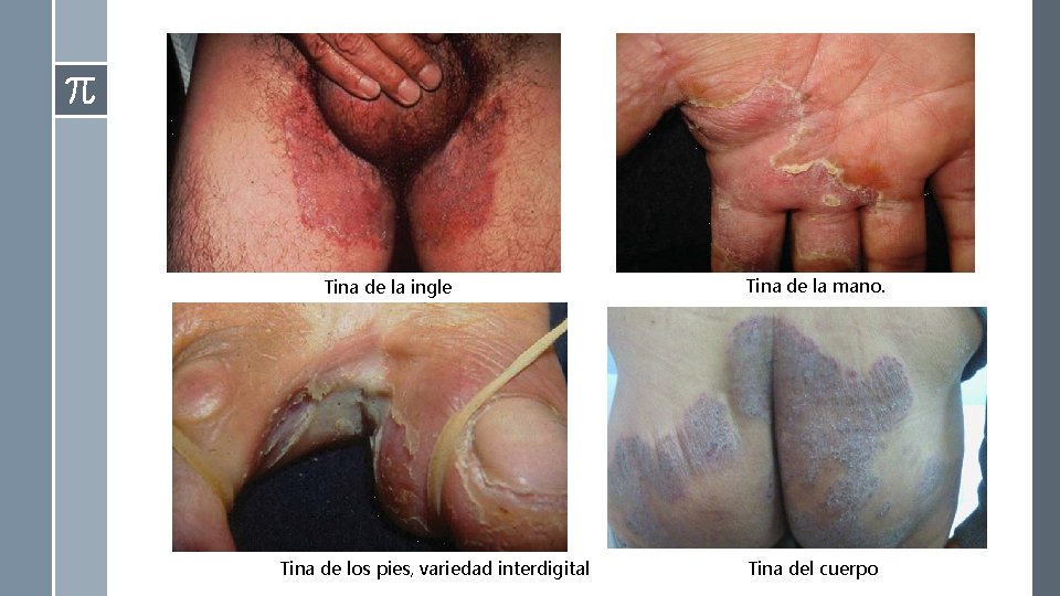 Tina de la ingle Tina de los pies, variedad interdigital Tina de la mano. Tina de la ingle Tina de los pies, variedad interdigital Tina de la mano.