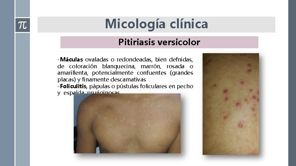 Micología clínica Pitiriasis versicolor -Máculas ovaladas o redondeadas, bien defnidas, de coloración blanquecina, marrón, Micología clínica Pitiriasis versicolor -Máculas ovaladas o redondeadas, bien defnidas, de coloración blanquecina, marrón,