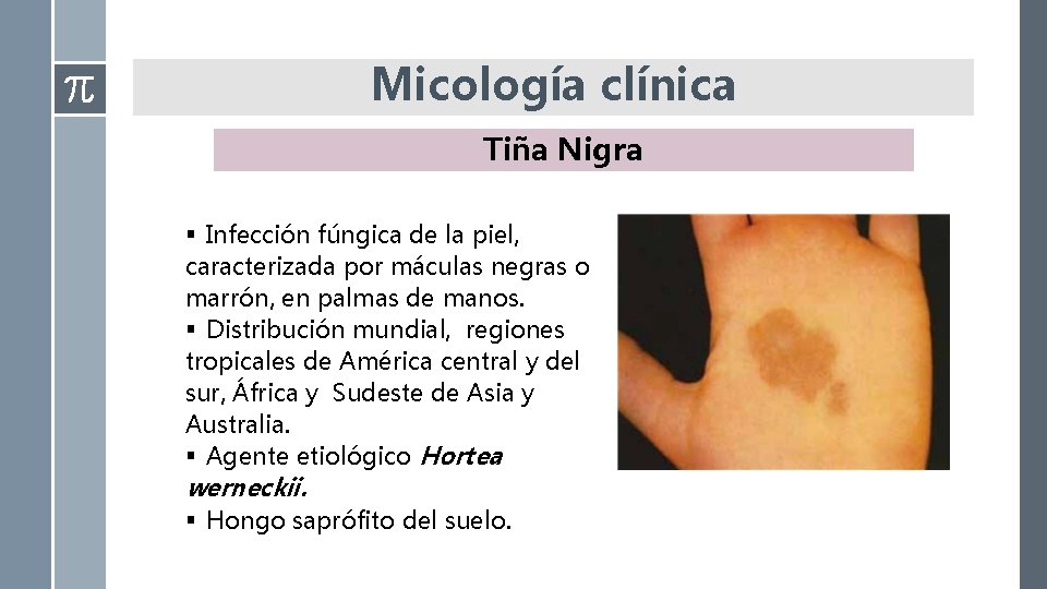 Micología clínica Tiña Nigra § Infección fúngica de la piel, caracterizada por máculas negras Micología clínica Tiña Nigra § Infección fúngica de la piel, caracterizada por máculas negras
