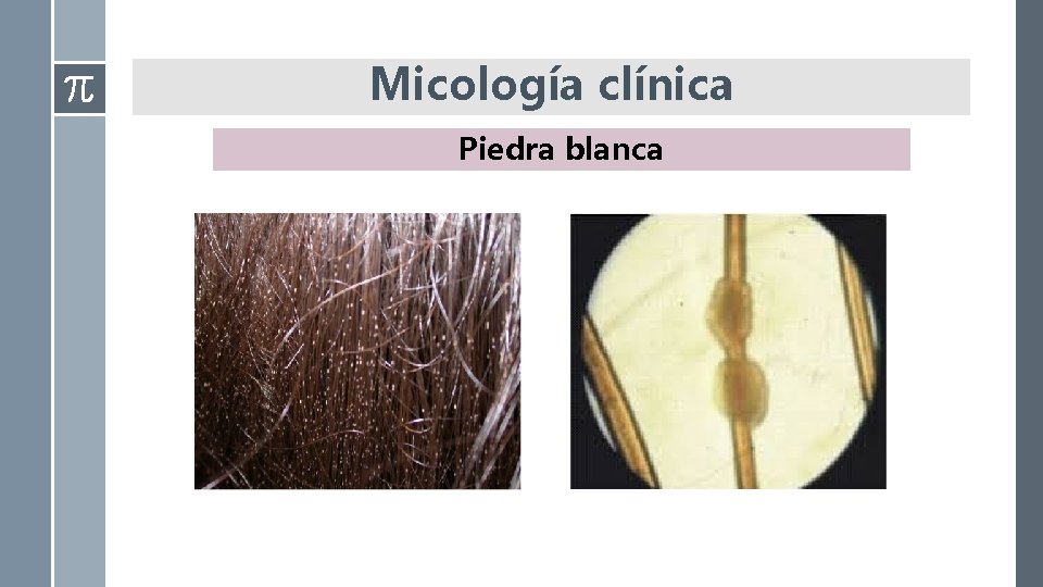 Micología clínica Piedra blanca Micología clínica Piedra blanca