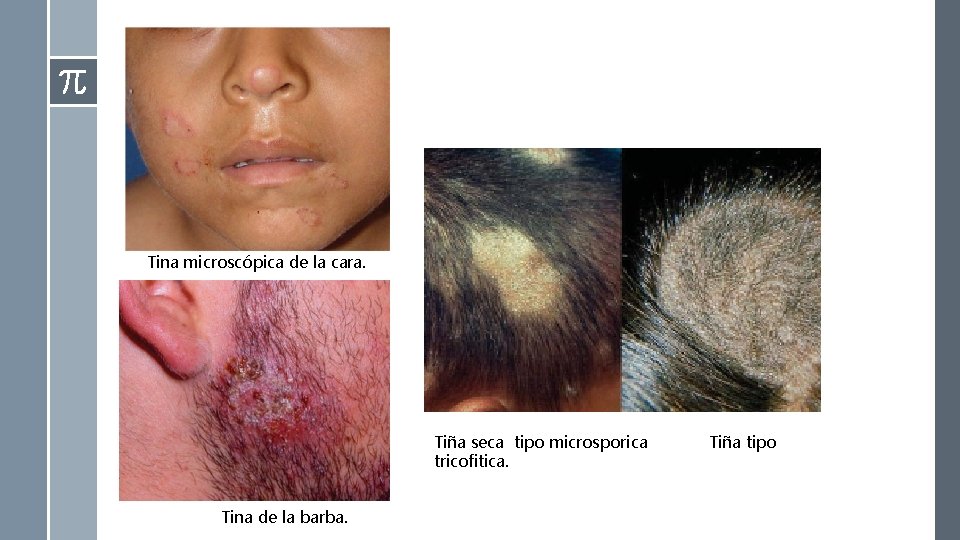 Tina microscópica de la cara. Tiña seca tipo microsporica tricofitica. Tina de la barba. Tina microscópica de la cara. Tiña seca tipo microsporica tricofitica. Tina de la barba.
