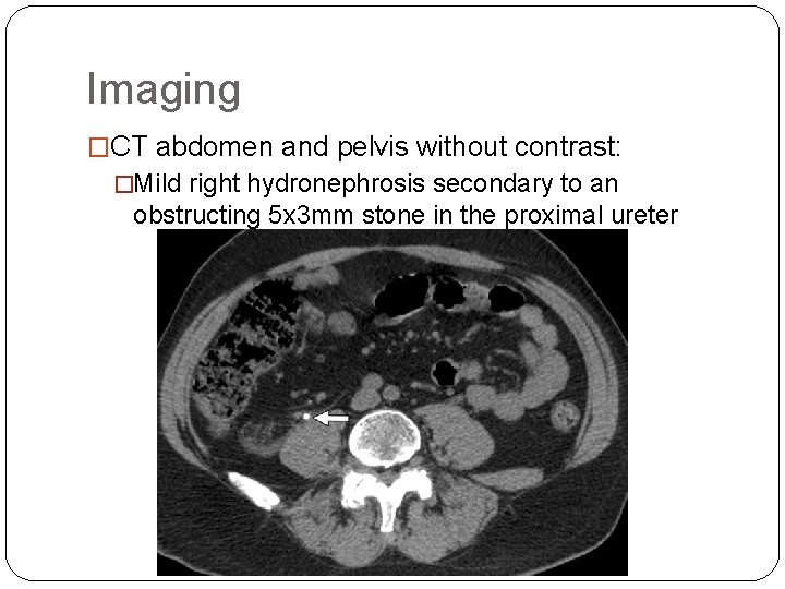 Imaging �CT abdomen and pelvis without contrast: �Mild right hydronephrosis secondary to an obstructing Imaging �CT abdomen and pelvis without contrast: �Mild right hydronephrosis secondary to an obstructing