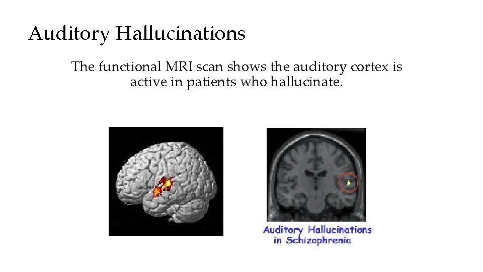 Auditory Hallucinations The functional MRI scan shows the auditory cortex is active in patients