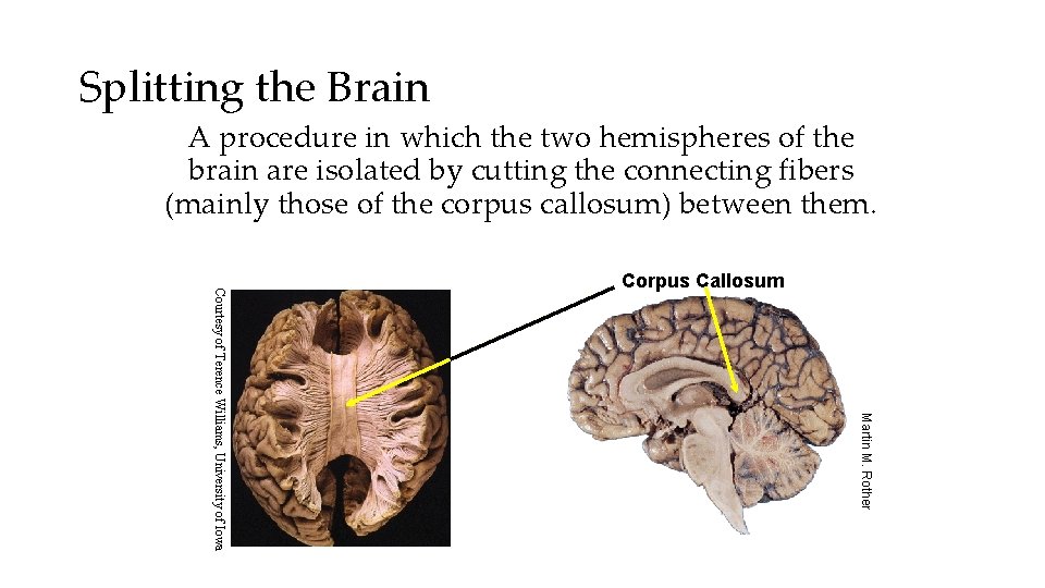 Splitting the Brain A procedure in which the two hemispheres of the brain are