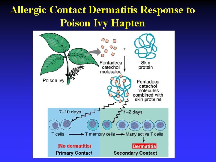 Allergic Contact Dermatitis Response to Poison Ivy Hapten Allergic Contact Dermatitis Response to Poison Ivy Hapten
