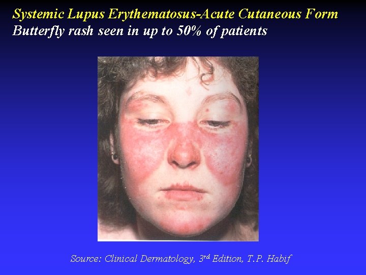 Systemic Lupus Erythematosus-Acute Cutaneous Form Butterfly rash seen in up to 50% of patients Systemic Lupus Erythematosus-Acute Cutaneous Form Butterfly rash seen in up to 50% of patients