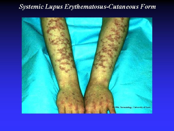 Systemic Lupus Erythematosus-Cutaneous Form Systemic Lupus Erythematosus-Cutaneous Form