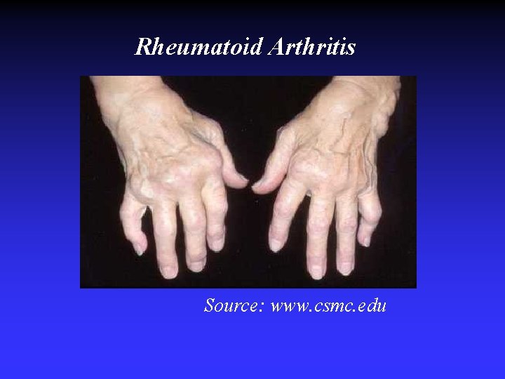 Rheumatoid Arthritis Source: www. csmc. edu Rheumatoid Arthritis Source: www. csmc. edu
