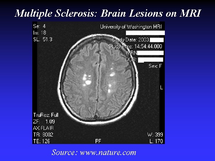 Multiple Sclerosis: Brain Lesions on MRI Source: www. csmc. edu Source: www. nature. com Multiple Sclerosis: Brain Lesions on MRI Source: www. csmc. edu Source: www. nature. com