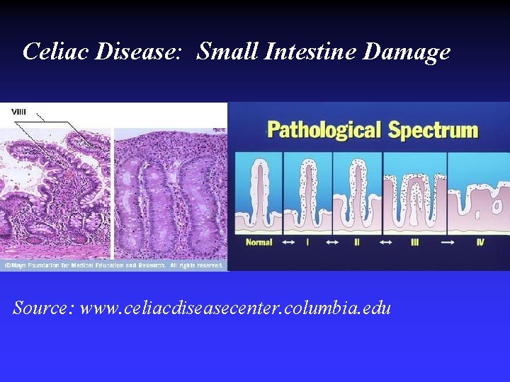 Celiac Disease: Small Intestine Damage Source: www. celiacdiseasecenter. columbia. edu Celiac Disease: Small Intestine Damage Source: www. celiacdiseasecenter. columbia. edu