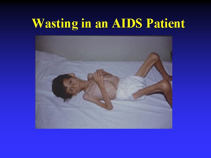 Wasting in an AIDS Patient Wasting in an AIDS Patient