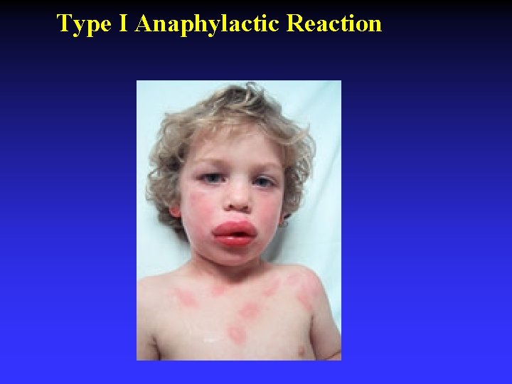 Type I Anaphylactic Reaction Type I Anaphylactic Reaction