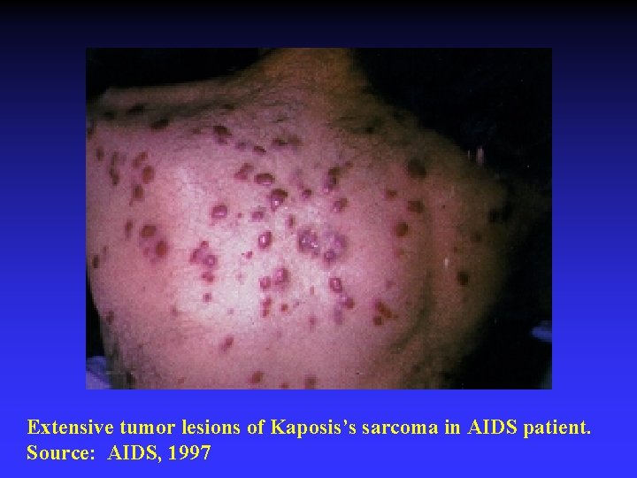 Extensive tumor lesions of Kaposis’s sarcoma in AIDS patient. Source: AIDS, 1997 Extensive tumor lesions of Kaposis’s sarcoma in AIDS patient. Source: AIDS, 1997