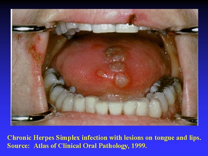 Chronic Herpes Simplex infection with lesions on tongue and lips. Source: Atlas of Clinical Chronic Herpes Simplex infection with lesions on tongue and lips. Source: Atlas of Clinical