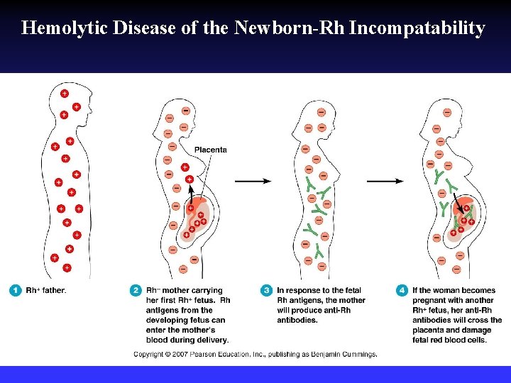 Hemolytic Disease of the Newborn-Rh Incompatability Hemolytic Disease of the Newborn-Rh Incompatability