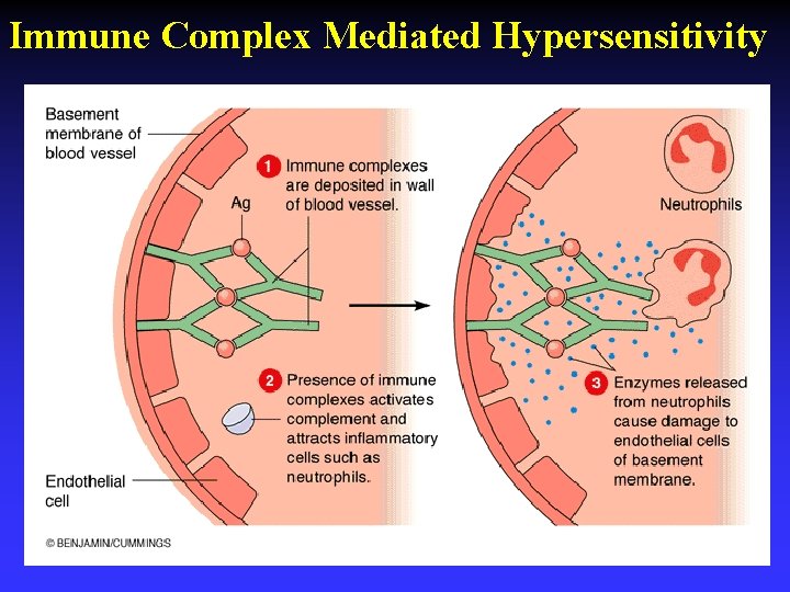 Immune Complex Mediated Hypersensitivity Immune Complex Mediated Hypersensitivity