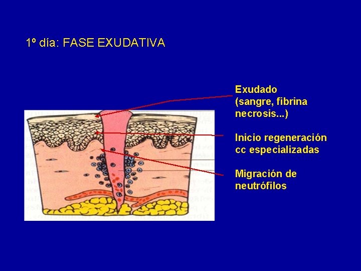 1º día: FASE EXUDATIVA Exudado (sangre, fibrina necrosis. . . ) Inicio regeneración cc