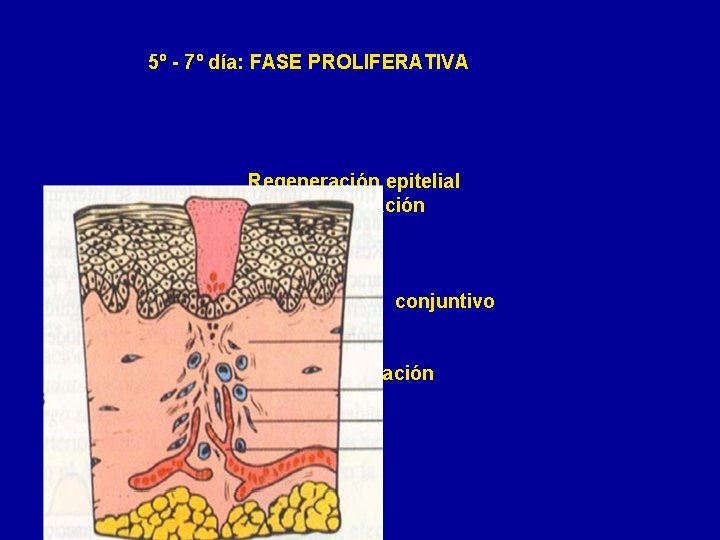 5º - 7º día: FASE PROLIFERATIVA Regeneración epitelial Tejido granulación Macrófagos Fibroblastos Síntesis tejido