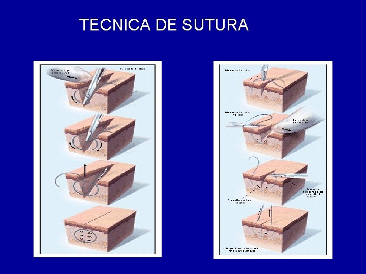 TECNICA DE SUTURA 