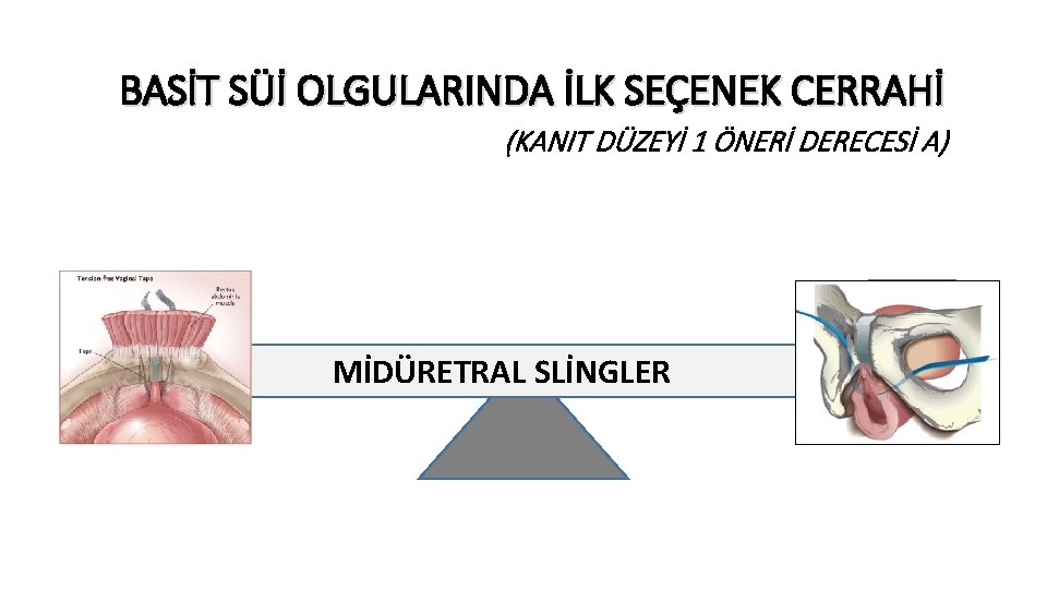 BASİT SÜİ OLGULARINDA İLK SEÇENEK CERRAHİ (KANIT DÜZEYİ 1 ÖNERİ DERECESİ A) TVT MİDÜRETRAL