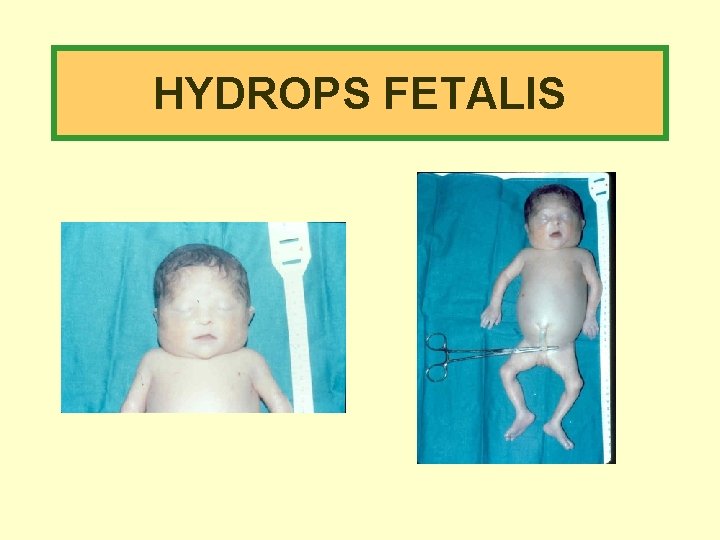 HYDROPS FETALIS 
