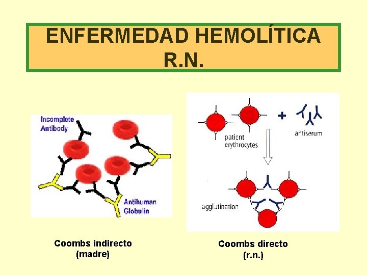 ENFERMEDAD HEMOLÍTICA R. N. Coombs indirecto (madre) Coombs directo (r. n. ) 