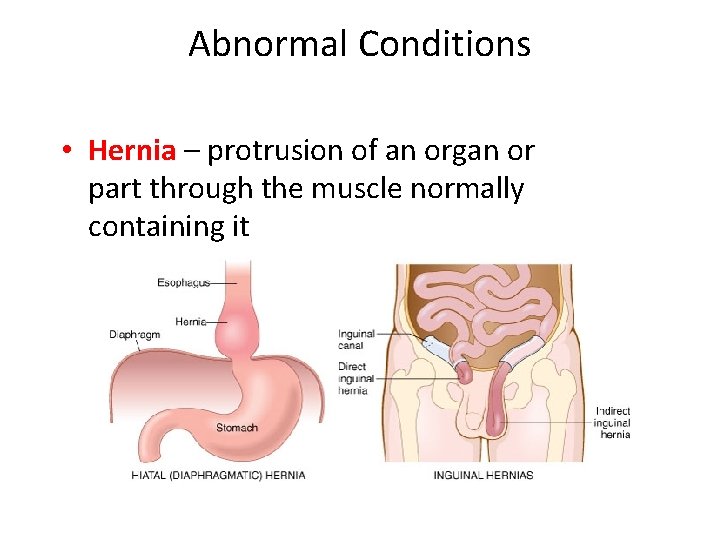 Abnormal Conditions • Hernia – protrusion of an organ or part through the muscle