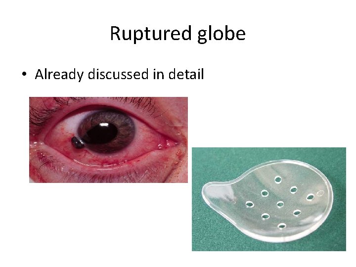 Ruptured globe • Already discussed in detail 