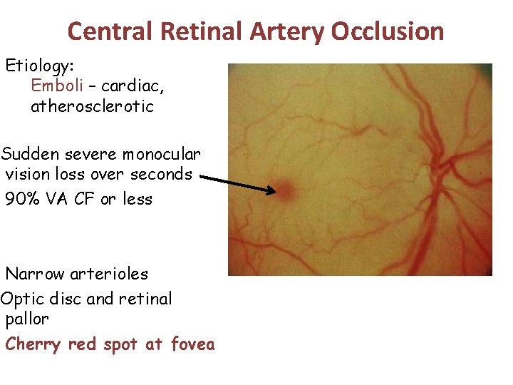 Central Retinal Artery Occlusion Etiology: Emboli – cardiac, atherosclerotic Sudden severe monocular vision loss