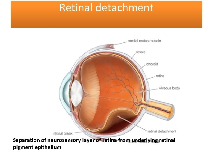 Retinal detachment Separation of neurosensory layer of retina from underlying retinal pigment epithelium 